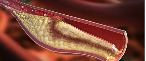 Repatha porazila Zetii. Dokáže více snížit cholesterol.